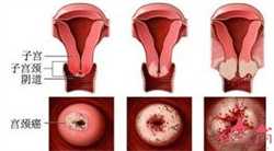 怀孕初期症状：怀孕初期腹痛正常吗