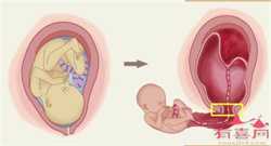 还不知道宫外孕什么时候打掉最合适，赶紧看看这个