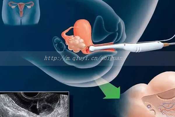 〖青岛试管哪里有〗青岛试管三代医院